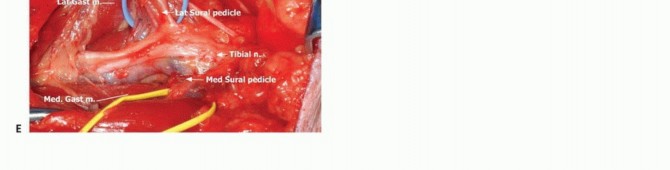 صورة طبية: استئصال الأورام المعقدة في الحفرة المأبضية وحماية الوريد الصافن الكبير: دليل شامل للمرضى مع الأستاذ الدكتور محمد هطيف