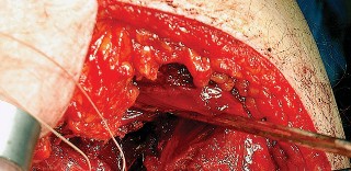 Illustration 72 for Unlock the Figure Posterior Approach to the Hip