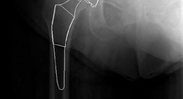 Illustration 13 for Mastering Direct Anterior Approach Hip Arthroplasty Without a Traction Table