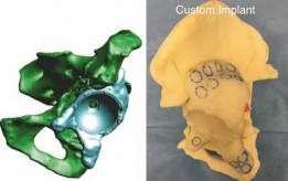 Illustration 4 for How We Tackled Massive Bone Loss in a Revision Hip Arthroplasty