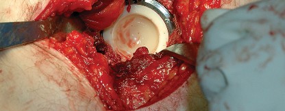 Illustration 47 for Unlock the Figure Posterior Approach to the Hip