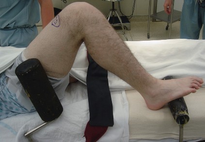 Illustration 19 for Mastering TKA: Essential Methods of Rotational Alignment