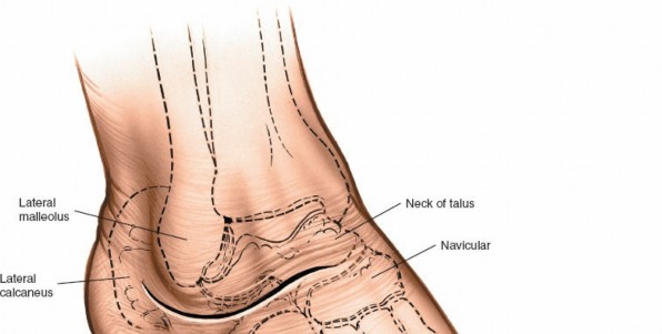 Achieve Optimal Exposure: Foot Lateral Approach to the Hindfoot