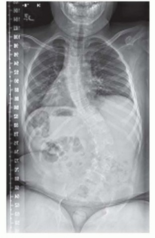 Rib to Pelvis VEPTR: Growth-Sparing Scoliosis Treatment