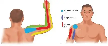 صورة توضيحية لـ متلازمة الكتف والرقبة: دليل المريض الشامل لاستعادة حركتك وحياتك