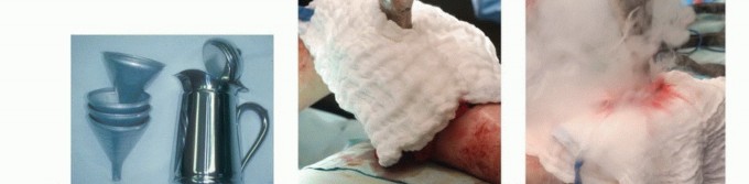 صورة توضيحية لـ تجنب الجراحة الكبرى: علاج أورام العظام بالنيتروجين السائل بتقنية الصب المباشر