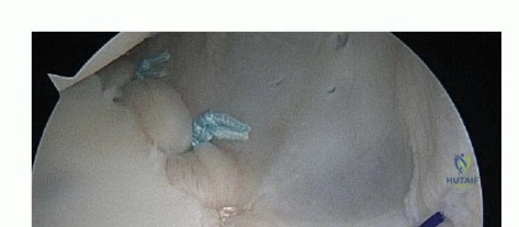 صورة توضيحية لـ إبهام القدم الأروح (الوكعة): دليل شامل للعلاج والتعافي مع الأستاذ الدكتور محمد هطيف في صنعاء