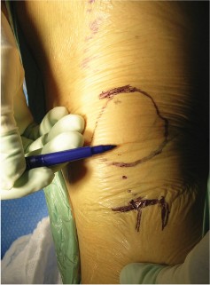 Illustration 9 for Cemented TKA Figure: Your Visual Guide to Surgical Success