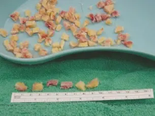 صورة توضيحية لـ جراحة مراجعة مفصل الورك المعقدة وزراعة العظام بالضغط: حلول متقدمة لتعويض مفصل الورك الفاشل