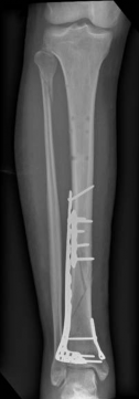 Illustration 16 for Complex Tibial Shaft Fracture: Plate Fixation for Plafond Extension