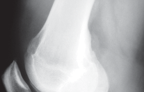 Illustration 4 for Unicompartmental Knee Arthroplasty: Master decisions with this b c figure guide.