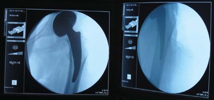 صورة طبية: مفصل الفخذ الصناعي قصير الجذع METHA: حلول مبتكرة للحفاظ على العظم في صنعاء مع الأستاذ الدكتور محمد هطيف