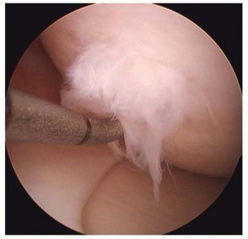 Treating Large Osteochondral Defects: Advanced Knee Solutions