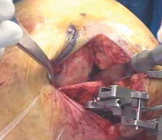 Illustration 53 for Knee Arthroplasty: Avoiding Pitfalls & Benefiting from UKA