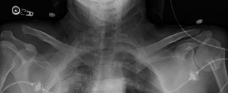 Illustration of ac joint injuries - Dr. Mohammed Hutaif