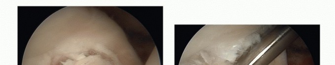 Cartilage Injuries: Repair Options to Preserve Your Joint Health