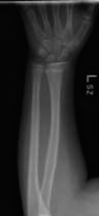 Illustration 3 for Pediatric Orthopedic Cases: Diagnose & Treat a Child's Wrist Fracture
