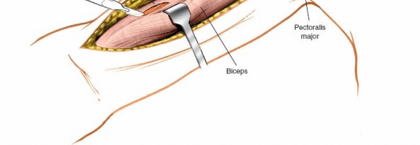 Illustration 10 for Humeral Shaft Anterior Approach: Master Surgical Techniques