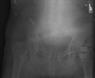 ATLS Protocol: Pelvic Fracture Workup & Management Explained