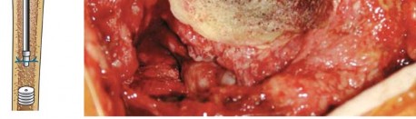 توضيح طبي: استبدال مفصل الورك الكلي بتقنية الإسمنت للفخذ: دليلك الشامل لنتائج تدوم طويلاً مع الأستاذ الدكتور محمد هطيف في صنعاء