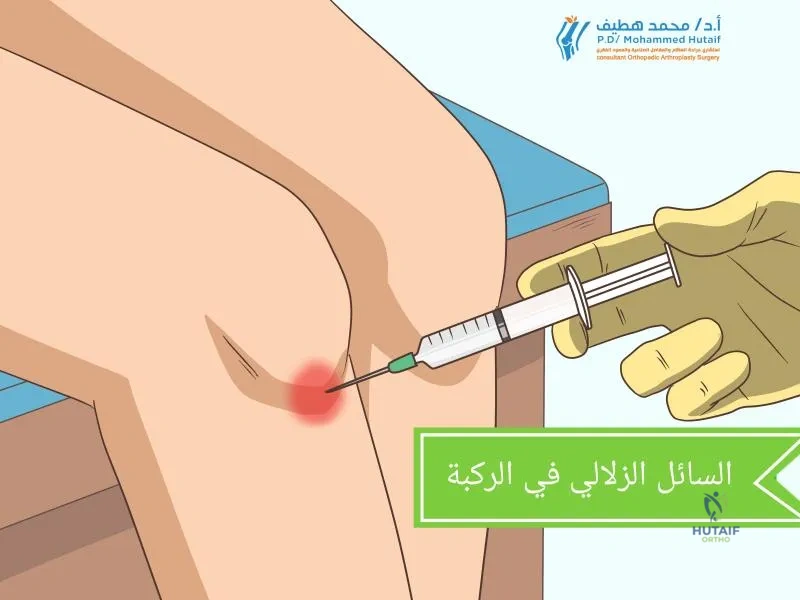 صورة مقربة لركبة عداء تم تدليكها أو معالجتها للعلاج، يظهر التركيز على العلاجات اليدوية.