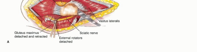 Illustration 20 for Beyond Amputation: Total Femur Resection with Endoprosthetics