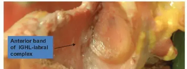 صورة توضيحية لـ وداعًا لآلام الكتف المتكررة: دليل شامل لعلاج عدم استقرار الكتف الأمامي بالمنظار