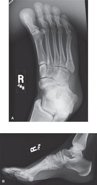 Fifth Metatarsal Fractures: Optimal Care for Athletes & Zone II