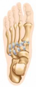 Fixing Lisfranc Injury: Tarsometatarsal & Intercuneiform ORIF