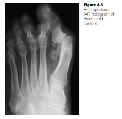 Oral Questions: The Rheumatoid Foot Exam Deconstructed
