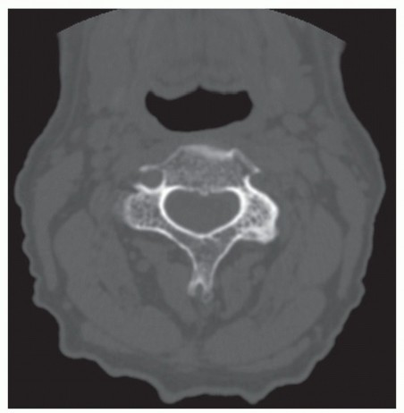 Illustration of lateral mass screw - Dr. Mohammed Hutaif