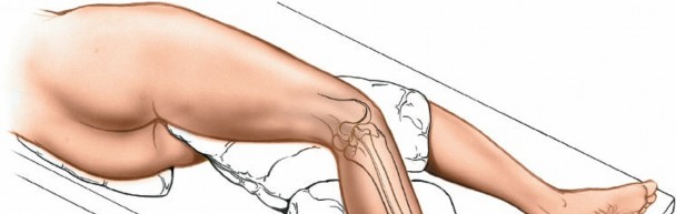 Master the Posterolateral Approach to the Tibia for Challenging Fractures