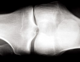 Illustration 80 for Knee Arthroplasty: Avoiding Pitfalls & Benefiting from UKA