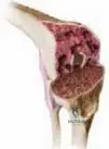 Illustration of arthroplasty with femoral bone - Dr. Mohammed Hutaif