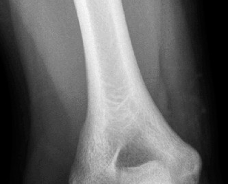 Solve Orthopedic Cases: Extensor Carpi Radialis Brevis & Elbow Pain