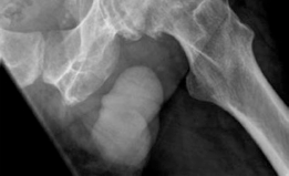 Illustration 4 for Patient Case: Resurfacing Primary Hip Arthroplasty for Lasting Relief