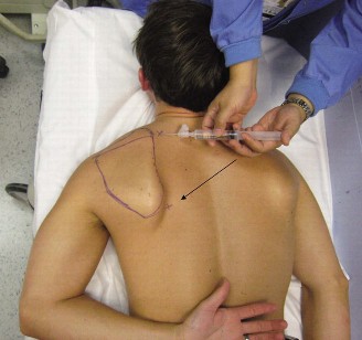 Illustration 87 for Acad Orthop Surg Challenge: Diagnose Shoulder Pain Case 1