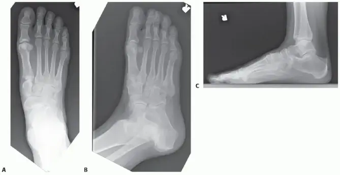 صورة توضيحية لـ دمج منتصف القدم (تثبيت مفصل منتصف القدم): دليل شامل للمرضى بقلم الأستاذ الدكتور محمد هطيف