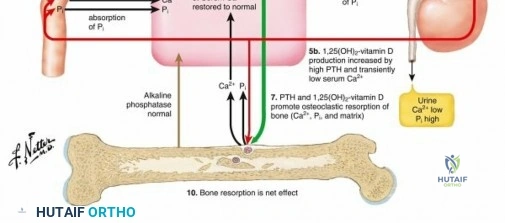 Illustration of nutritional rickets nutritional - Dr. Mohammed Hutaif
