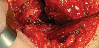 Illustration 75 for Unlock the Figure Posterior Approach to the Hip