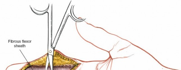 Illustration 151 for Essential Surgical Approaches: Uncover Every Aspect of the Wrist