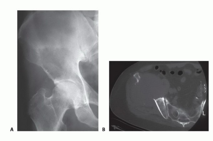 Plain Radiograph Showing MBD: Surgical Planning to Prevent Failures