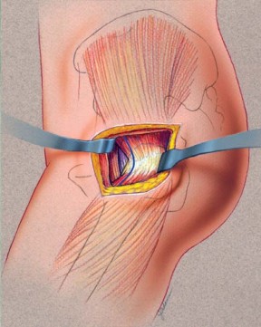 وضعية المريض للوصول الجانبي المباشر المعدل