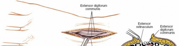 Illustration 21 for Essential Surgical Approaches: Uncover Every Aspect of the Wrist