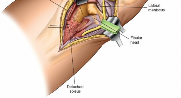 Figure 18: Layered closure of the surgical wound.