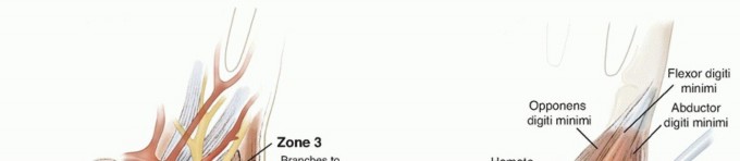 Illustration of hook of the hamate - Dr. Mohammed Hutaif