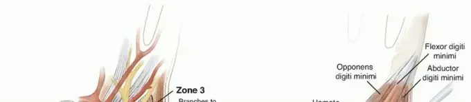 صورة توضيحية لـ متلازمة النفق الرسغي الزندي (نفق غويون): دليل المريض الشامل مع الأستاذ الدكتور محمد هطيف