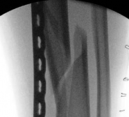 Illustration 23 for Tibial Fracture Extending into the Plafond: Intramedullary Secrets