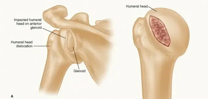 صورة توضيحية لـ وداعًا لخلع الكتف المتكرر: علاج فقدان عظم رأس العضد لاستعادة استقرار الكتف (د. محمد هطيف)