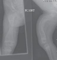 Multiple Percutaneous Osteotomies & Nailing for OI Function